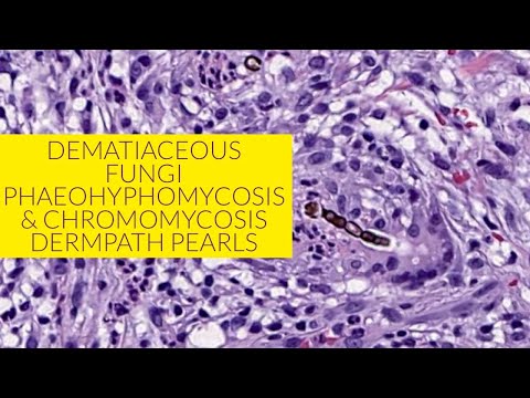 Dematiaceous fungi - phaeohyphomycosis and chromomycosis unknown 13