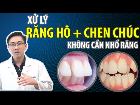 cách vệ sinh răng miệng cho người niềng răng tại Kemtrinam.vn