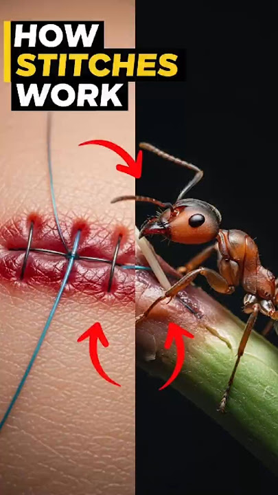 Using Ants as Stitches to Heal Wounds