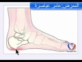 مسمار عظم في كعب القدم الاسباب والعلاج موضوع شامل ومبسط مسمار عظم في كعب القدم الاسباب والعلاج موضوع شامل ومبسط