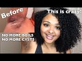 HOW I GOT RID OF BOILS IN MY ARMPIT | HIDRADENITIS SUPPURATIVA