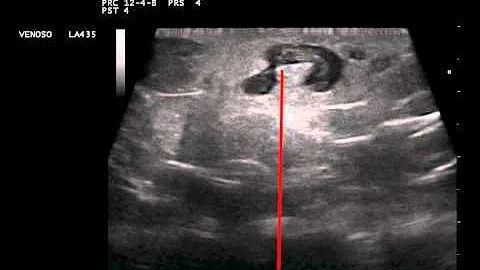 Come riconoscere i sintomi della flebite?