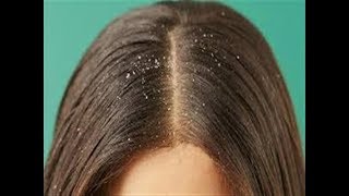 ارخص وابسط طريقة للتخلص من قشرة الشعر طبيعيا من اول استخدام مجربة
