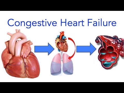 congestive-heart-failure-(chf)-explained---made-easy