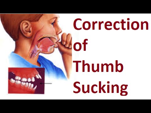 sucking orthodonture thumb