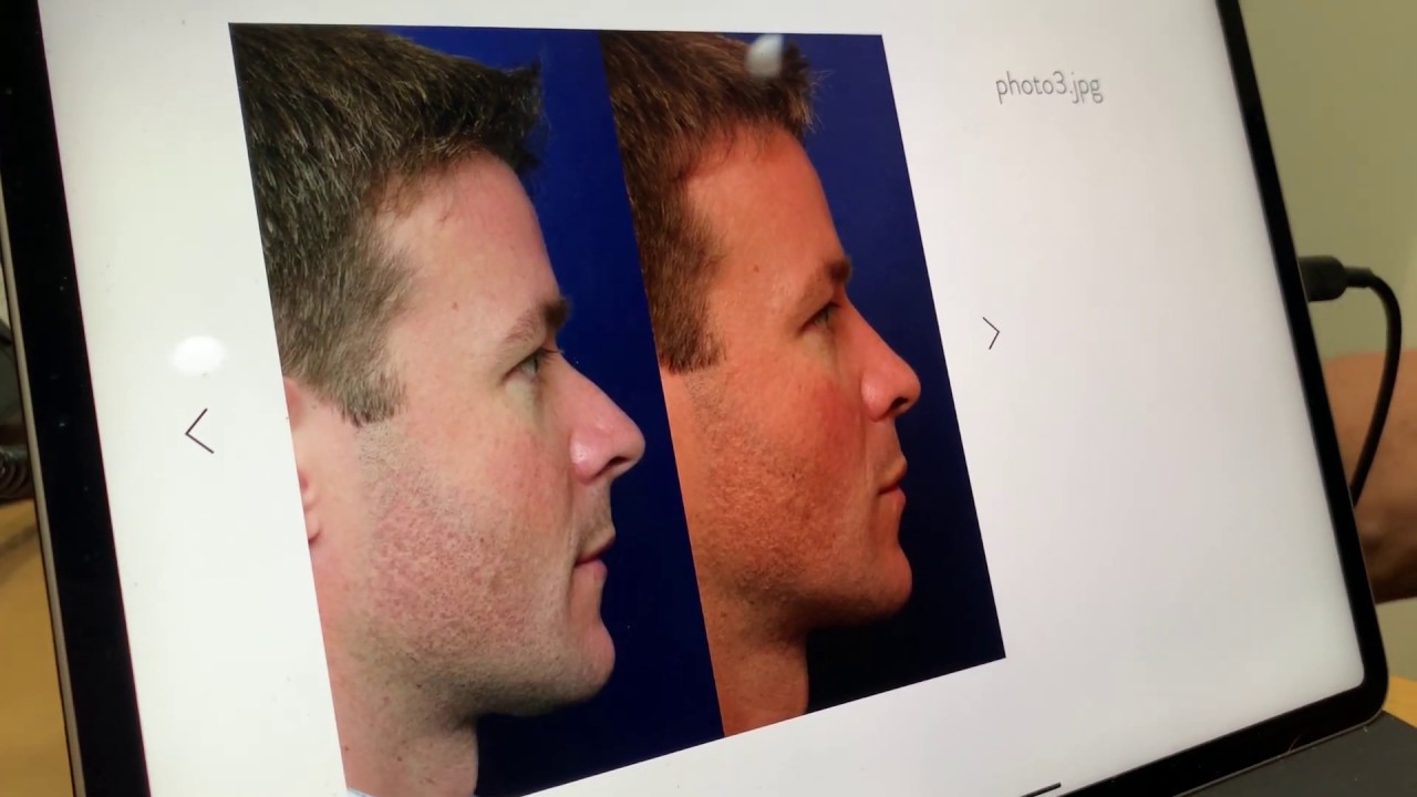 Dr. Toby Mayer on Male Rhinoplasty