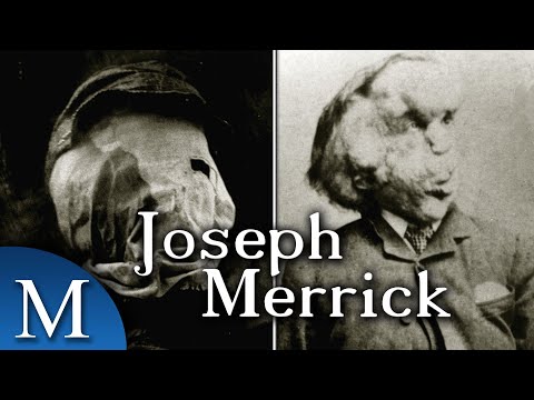 Video: Der Elefantenmensch Joseph Merrick: Eine Lebensgeschichte