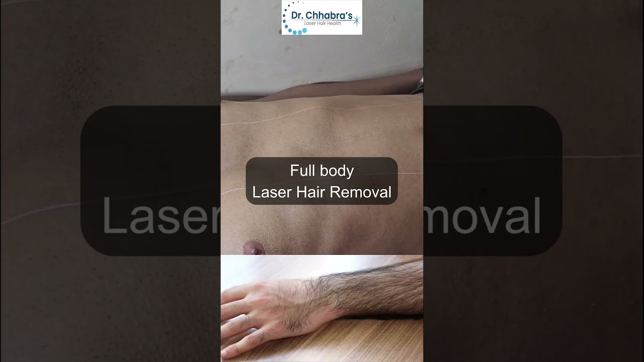 Full Body Laser Hair Removal