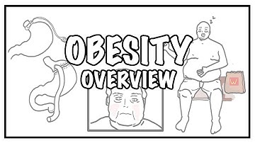 Approach to OBESITY and Weight gain - causes, risk factors, BMI, complications and treatment