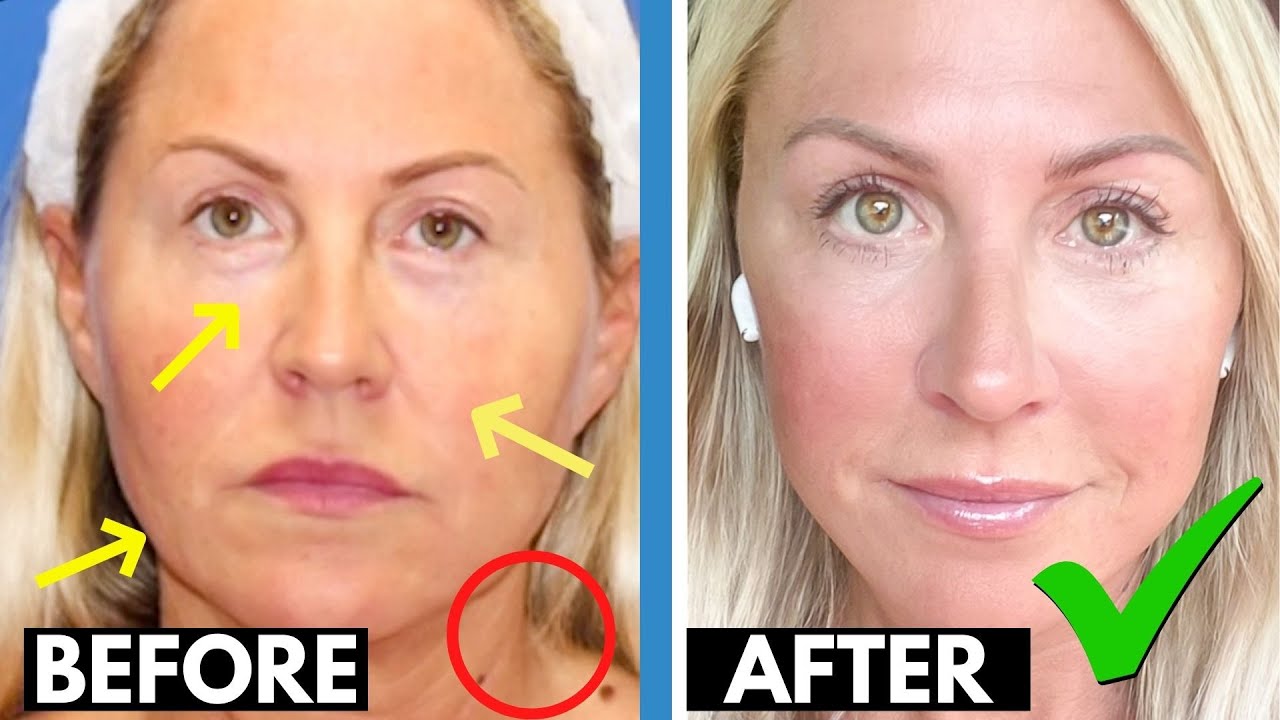 facelifts for women over 50 before and after        <h3 class=