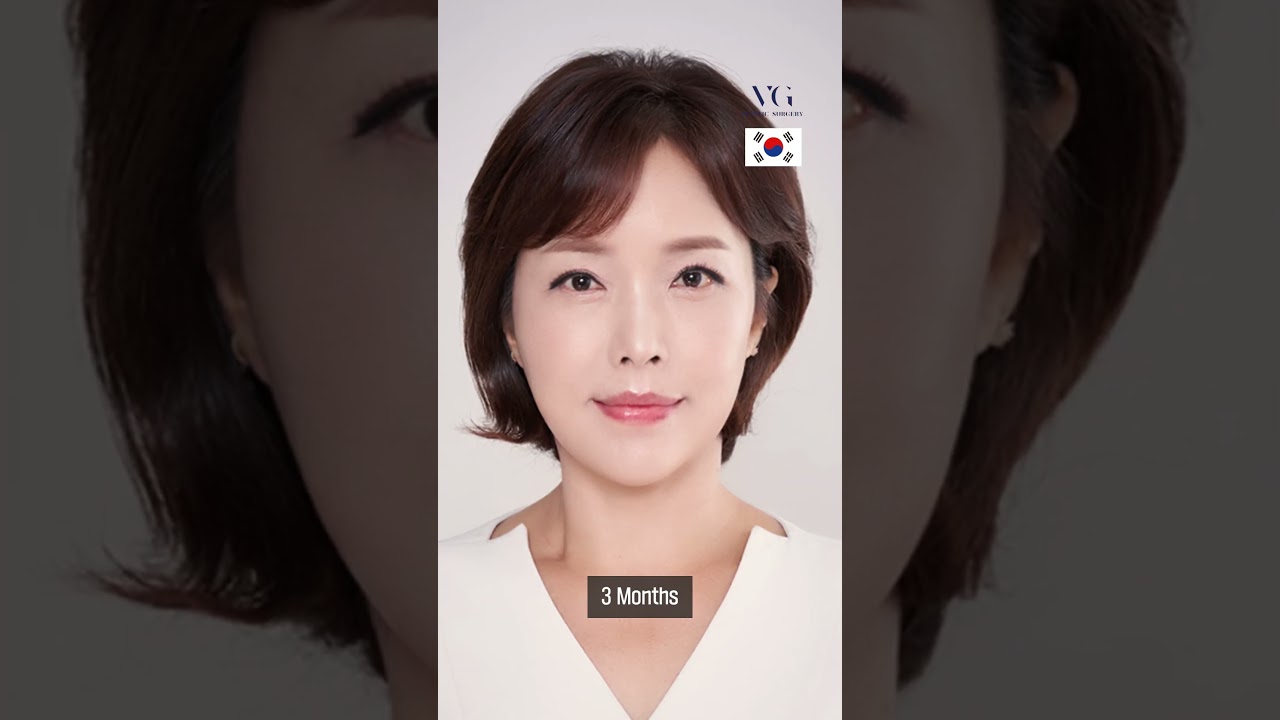 [Веригүд гоо сайхны мэс заслын эмнэлэг] #НүүрӨргөх Нүүр өргөх мэс заслын дараа 100% сэтгэл ханамжтай байх өмнөх болон дараах бичлэг👍👍 10 насаар илүү залуужих залуу төрхийг Веригүд гоо сайхны мэс заслын эмнэлгээс.