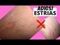 Como ELIMINE Las Fastidiosas Estrías❌LA VERDAD QUE NO TE QUIEREN DECIR❌|| MI HISTORIA REAL