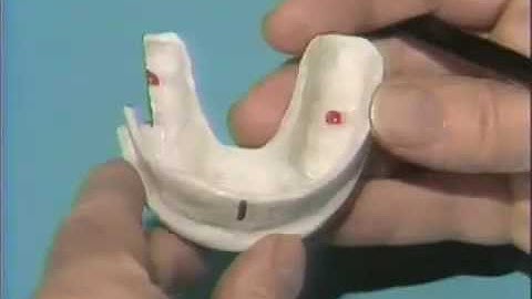 Custom Impression Tray Construction