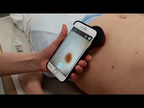 Video: Födelsemärke Inflammerat: Vad Man Ska Göra, Vilken Läkare Man Ska Kontakta