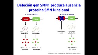 Deleción del gen SMN1. Video 17