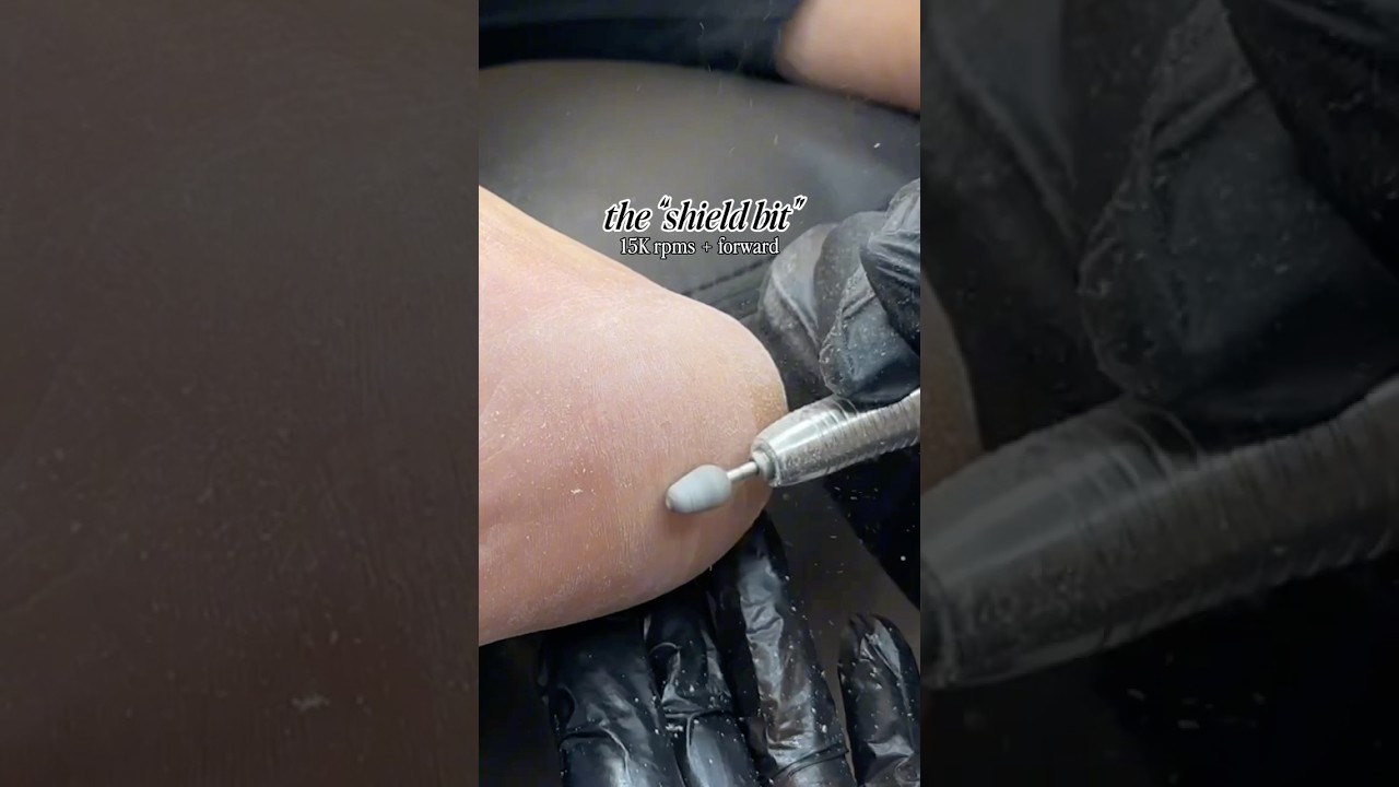 foot callus magic 🪄how to remove callus 