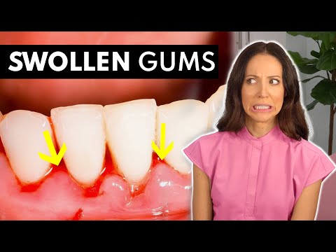 Video: Hvor gjør gingivitt vondt?