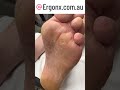 Satisfying Slow Motion Corn &amp; Callus Removal by Podiatrist #FootCare #SatisfyingVideos