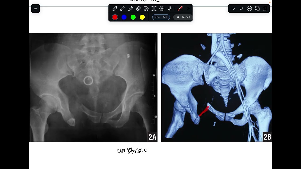 orthopedic - pelvic fracture 