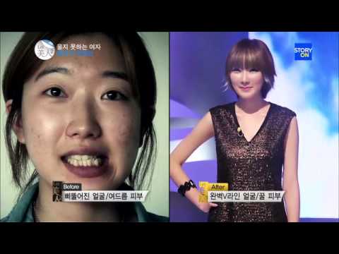 Gangnam Style TOP Plastic Surgery, Best Before and After - South KOREA