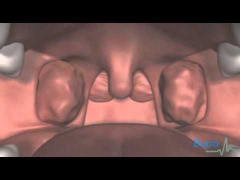 Adenoid kystique carcinome Pronostic, symptômes et traitement