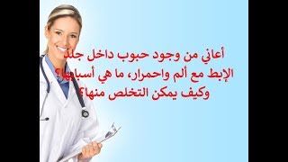 وجود حبوب داخل جلد الإبط مع ألم واحمرار، ما هي أسبابها وعلاجها؟