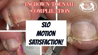 👣Satisfying Ingrown Toenail Compilation with Slo Motion 👣