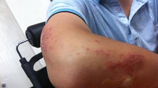 What is CIC-Rearranged Sarcoma? Symptoms, Diagnosis & Treatment