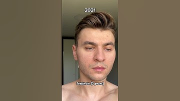 Tretinoin 3 years | before and after