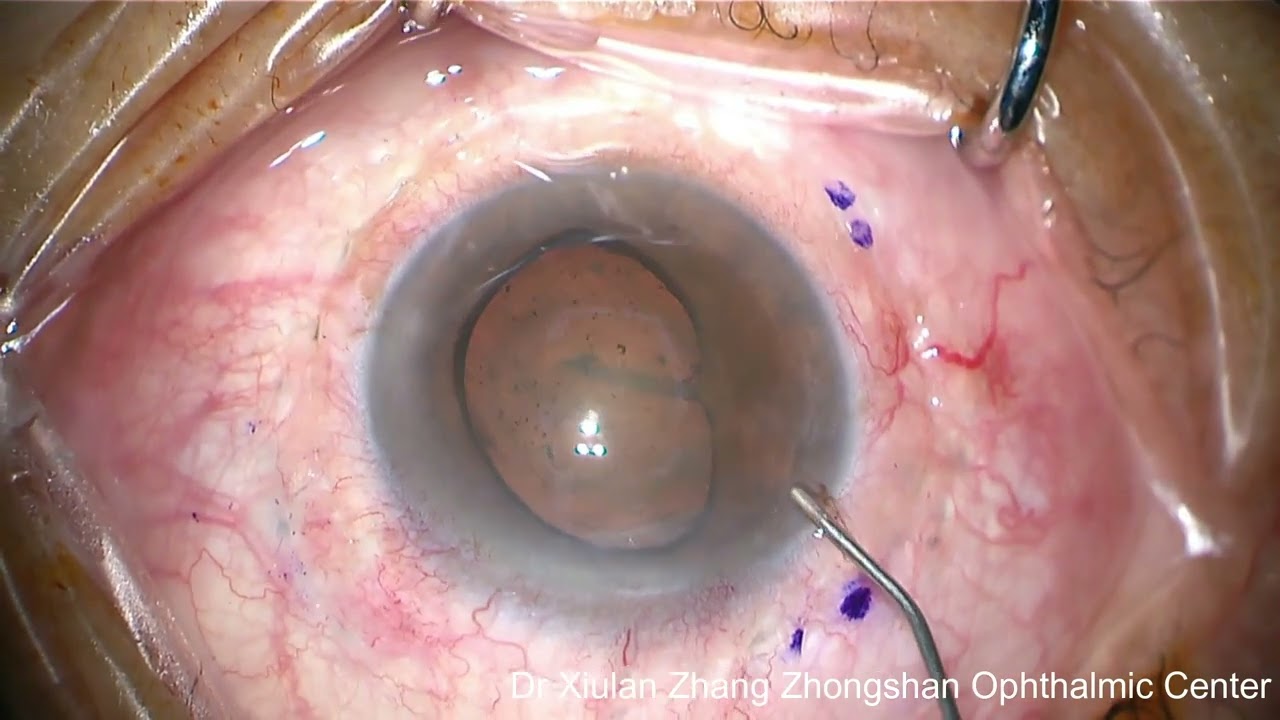 116. Transscleral cyclophotocoagulation (TSCPC)