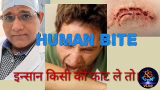 Human bite.इन्सान किसी को काट ले तो।घर पर करे ये काम।लापरवाही घातक हो सकती है।human bites human.