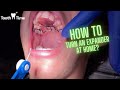 How to turn an Expander at home -  Braces Orthodontics - Tooth Time Family New Braunfels