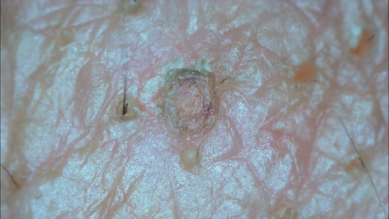 0212 keratin plug removal cheek YouTube