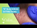 Blackheads Extractions K s 3rd Treatment