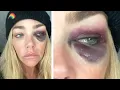Denise Richards Divorce Docs Allege Domestic Abuse SHOCKING Images of Black Eye