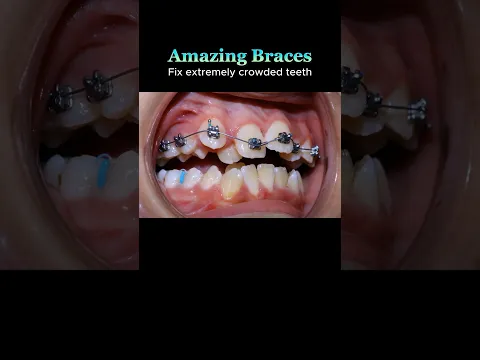 Amazing of braces: Fix extremely crowded teeth process. 30 months duration #braces #orthodontics