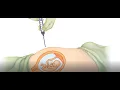 Amniocentesis and CVS Animation