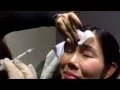 How to get rid of frown lines by Dr Carolyn Choy at Ultimate aesthetics