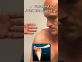 Lagu Severe AC Joint Dislocation! Explained By Orthopedic Surgeon #shorts #shoulder #surgeon