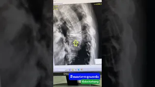  ทำไมกระดูกสันหลังถึงยุบตัว และมีสาเหตุอะไรบ้าง 