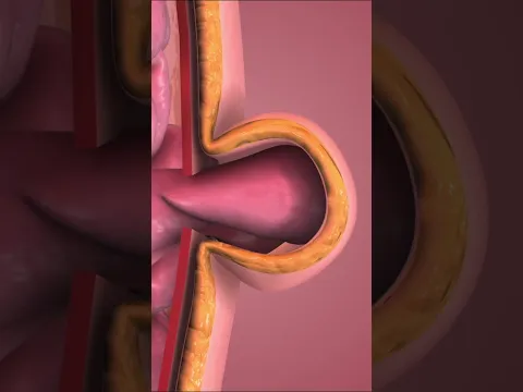 What does a Hernia look like inside your body? 🤔