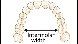Measurement of Intermolar Width on a Model for Orthodontic Treatment by Dr Mike Mew