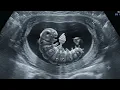Fake ultrasound