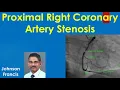 Proximal Right Coronary Artery Stenosis