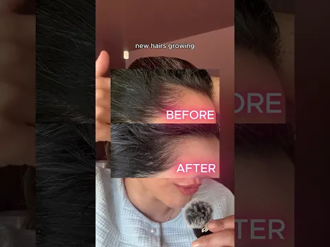 12 WEEK CURRENTBODY LED HAIR GROWTH HELMET BEFORE & AFTER ad