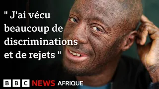 « Les gens me regardent comme si j’étais un monstre »