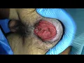 Download Lagu Prolapso Rectal