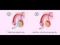 Aspiration of Bone cyst CPT code - simplify medical coding