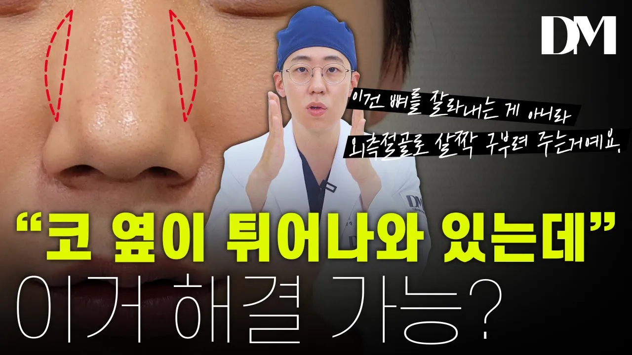 콧대 옆이 튀어나와있는 분들 정말 많으실 겁니다. 이거 고민이셨던 분들은 꼭 보세요!!! #외측절골 #코성형 #내측절골