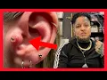 PIERCING BUMP Treatment What is Keloid Everything You Need To Know